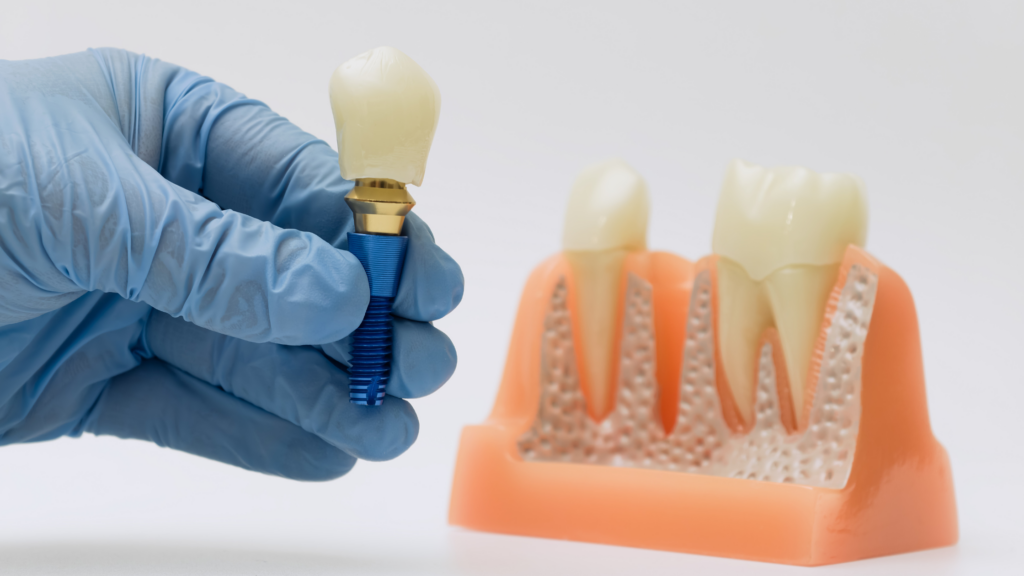 Gloved hand holding dental implant near jaw model